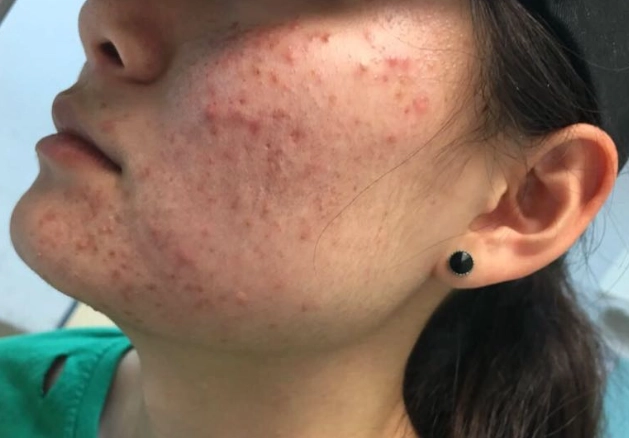 青春期痘痘長不停