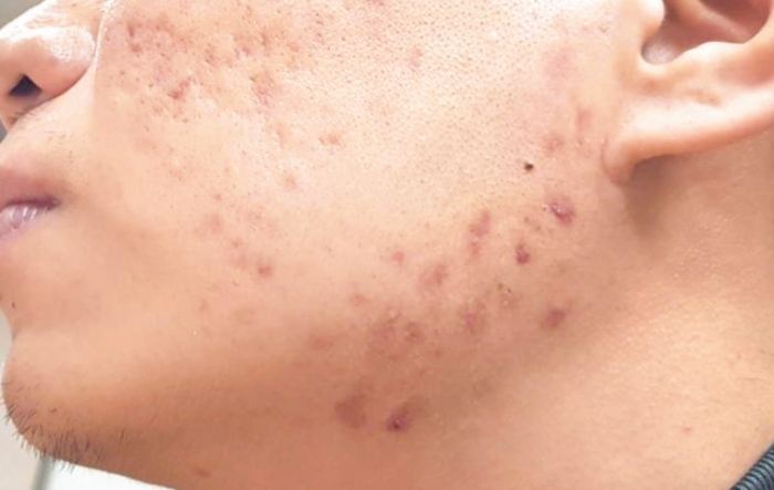 天花症狀治療 天花症狀治療