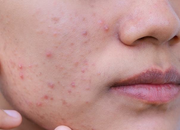 痘瘡治療方法 痘瘡治療方法