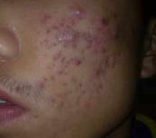 痘瘡預防措施 痘瘡預防措施