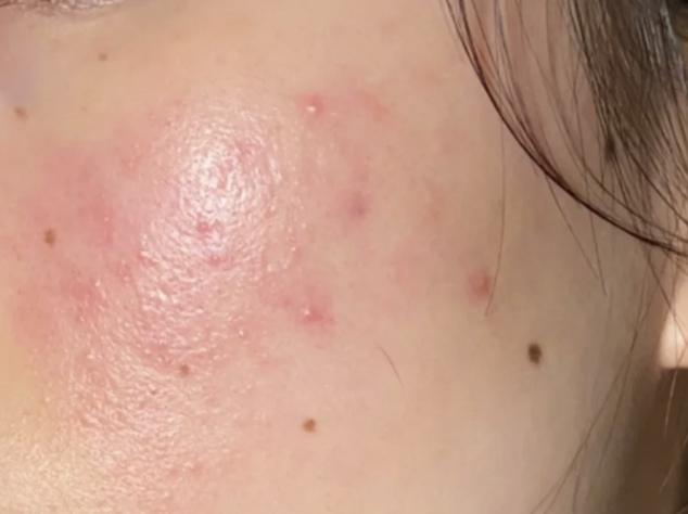 暗瘡發炎處理方法 暗瘡發炎處理方法