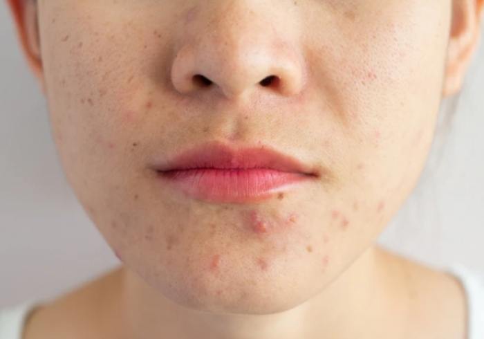 暗瘡發炎症狀 暗瘡發炎症狀