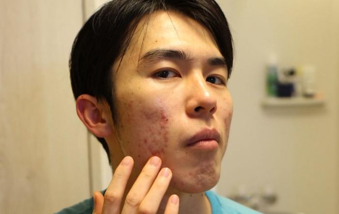 痘痘消炎藥 痘痘消炎藥