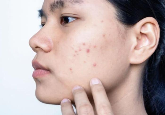 暗瘡印去除方法