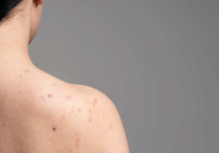 背部痘痘食療 背部痘痘食療