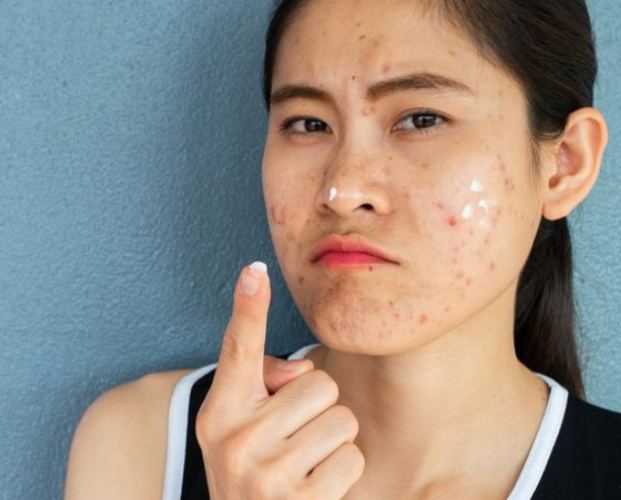 青春期暗疮治療