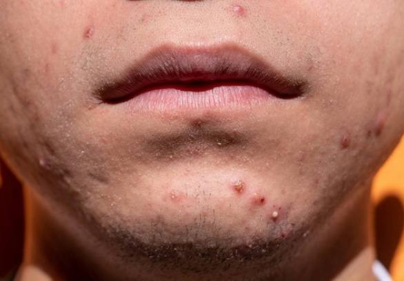 屁股痘痘硬塊消除