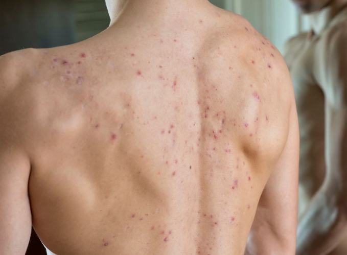 改善背部暗瘡湯水 改善背部暗瘡湯水