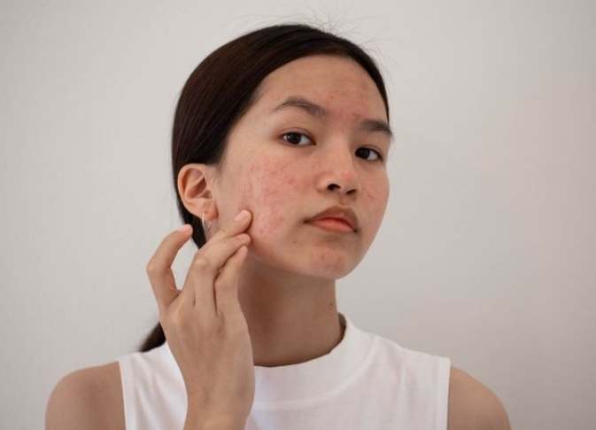 青春痘預防方法