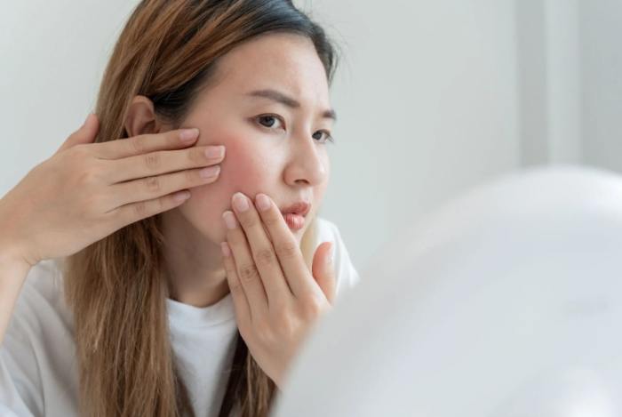 青春期暗疮治療