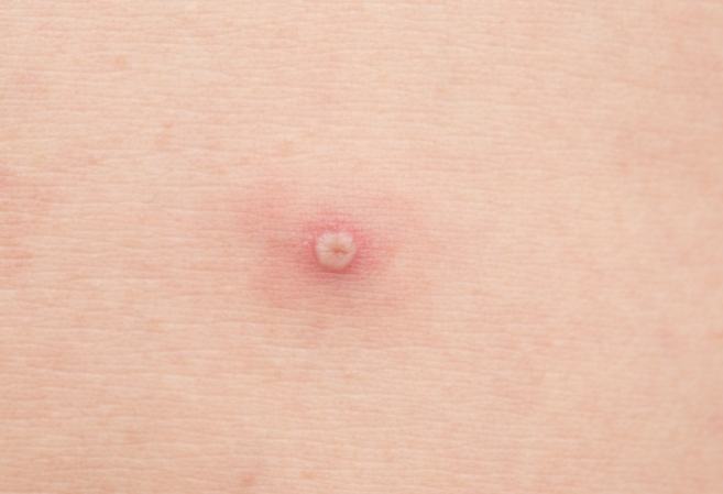 臀部毛囊炎症狀