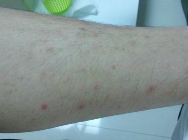 毛囊炎治療方法