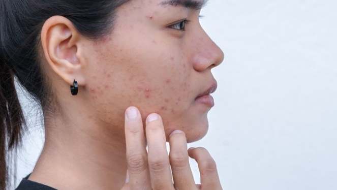 青春痘洗臉方法