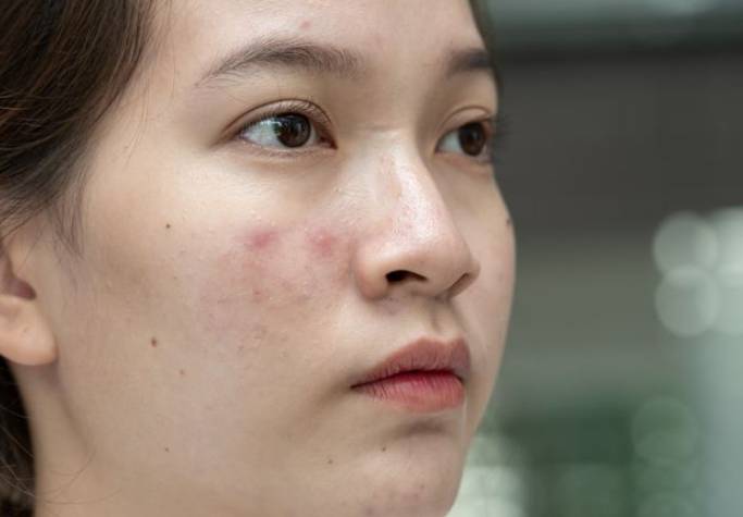 青春痘洗臉方法