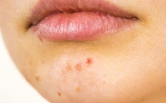 痘痘药膏排行榜 痘痘药膏排行榜