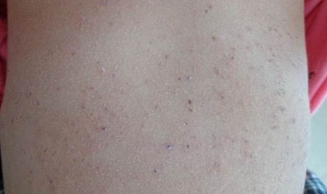 臀部毛囊炎症狀