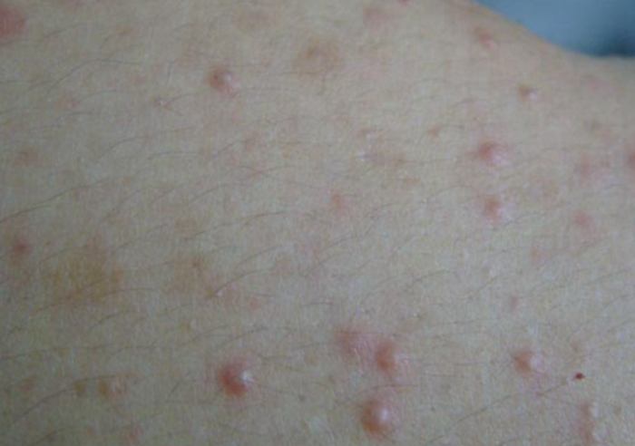 毛囊炎治療方法