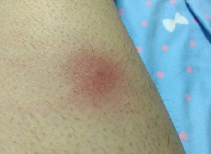 臀部毛囊炎症狀