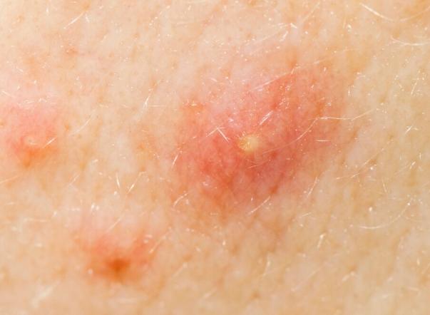 毛囊炎治療方法