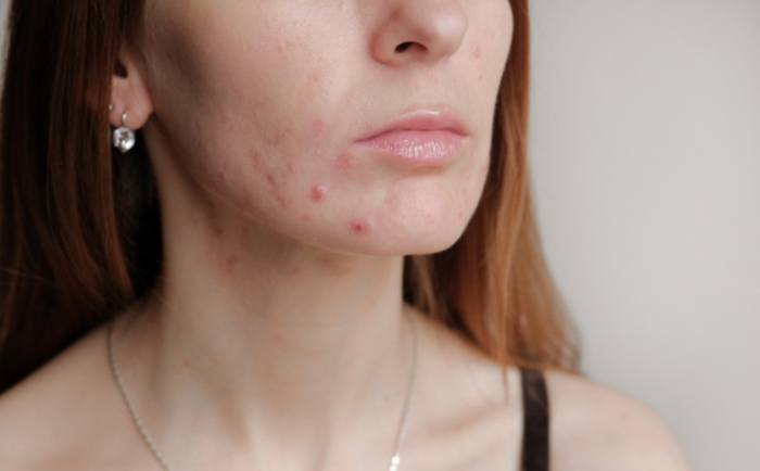 痘痘药膏怎麼選 痘痘药膏怎麼選