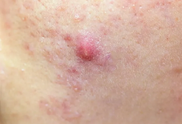 痘疤藥膏比較 痘疤藥膏比較