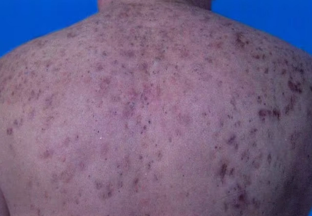 痘疤消除產品 痘疤消除產品