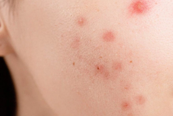 囊腫型痘痘為什麼長