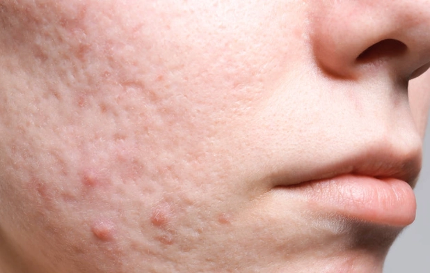 囊腫型痘痘為什麼長