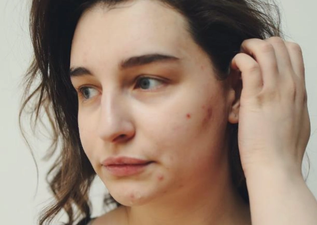 痤疮 痘痘 区别 痤疮 痘痘 区别