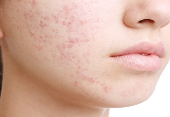 痘疤消除產品 痘疤消除產品