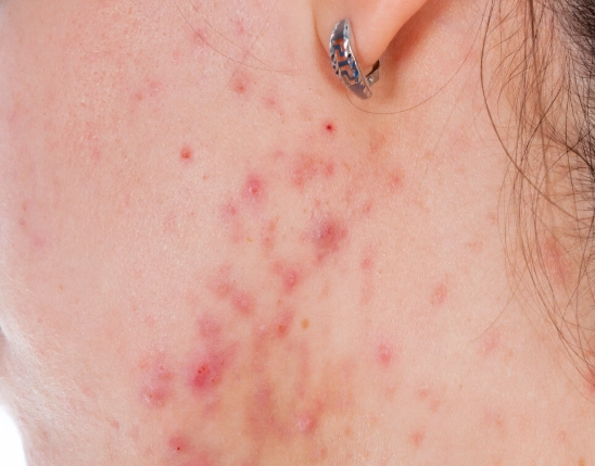 痘疤藥膏比較 痘疤藥膏比較