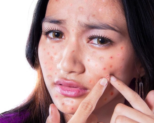 囊肿性痤疮原因