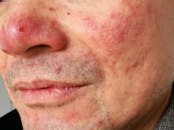 囊肿性痤疮原因