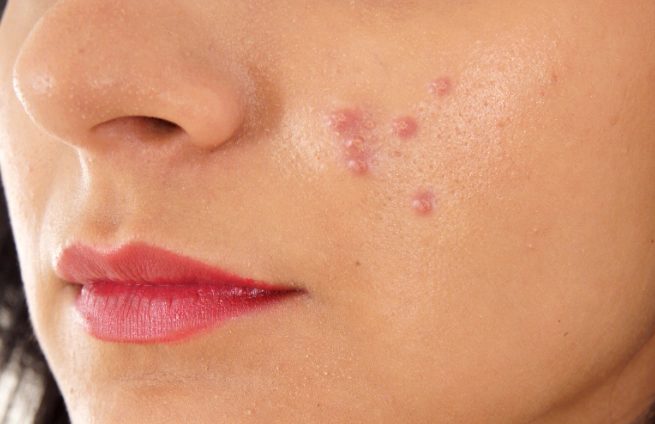 痘疤消除產品 痘疤消除產品