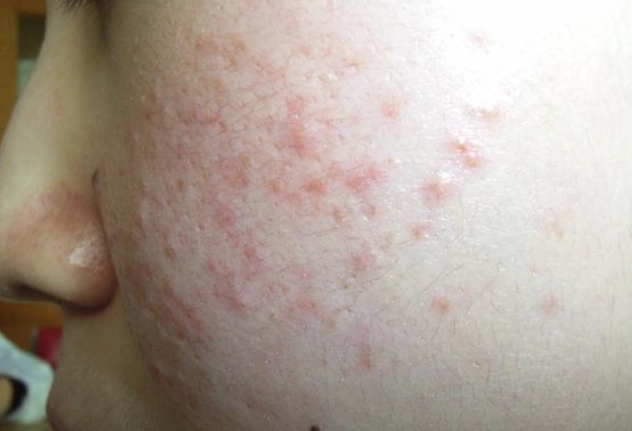 囊腫型痘痘為什麼長