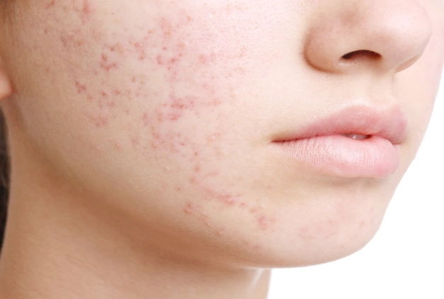 痘疤藥膏比較 痘疤藥膏比較