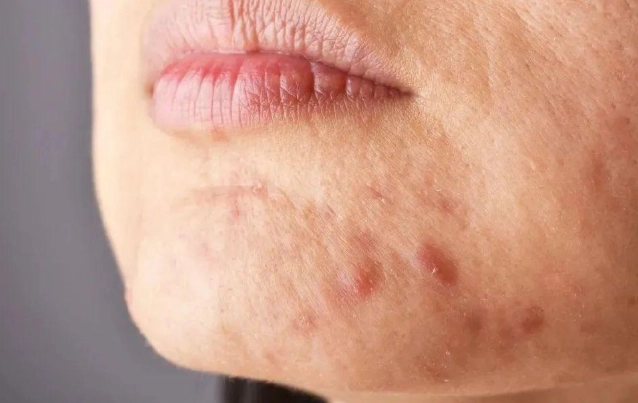 痘疤消除產品 痘疤消除產品