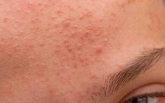 痘疤藥膏比較 痘疤藥膏比較