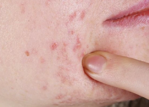 痤疮症状 痤疮症状