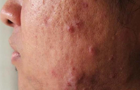 痘疤藥膏比較 痘疤藥膏比較