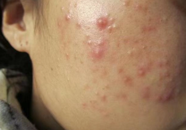 痤疮症状 痤疮症状