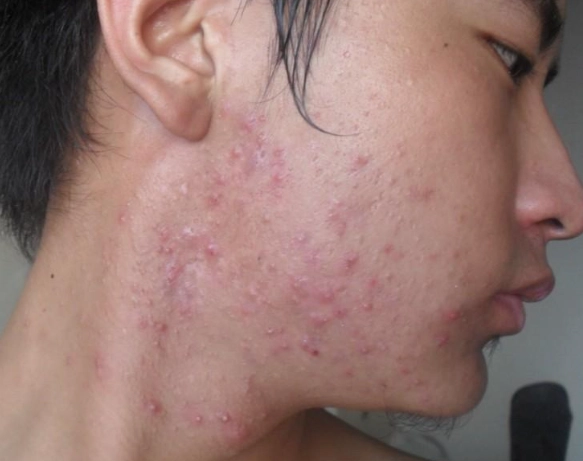 青春痘治療
