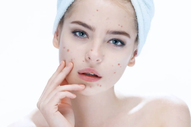 痘痘口服消炎药