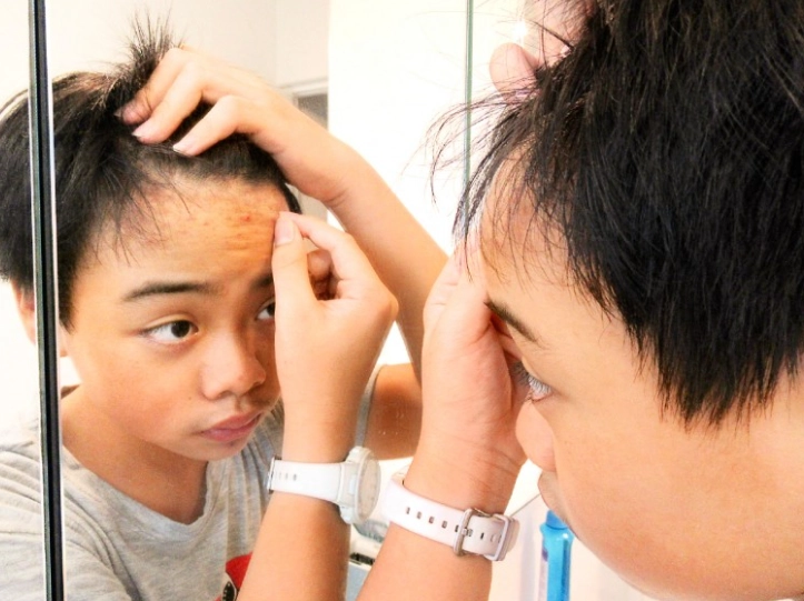 痘痘 嚴重 看醫生