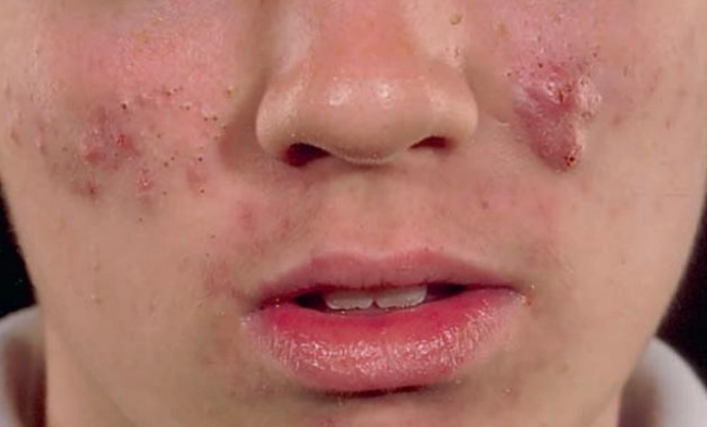 青春痘治療方法