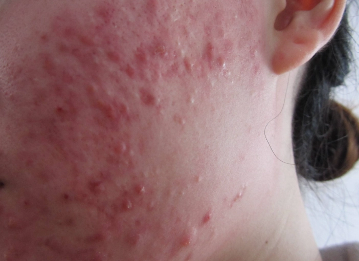 青春痘治療方法