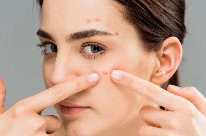 青春痘口服抗生素