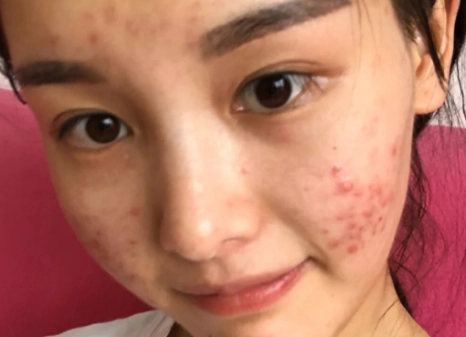 痘痘 嚴重 看醫生