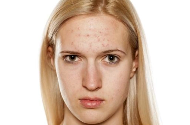 痘痘藥副作用 痘痘藥副作用