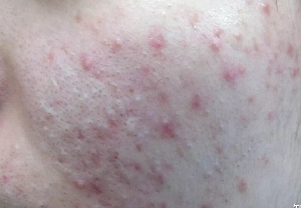 痘痘消炎藥膏推薦